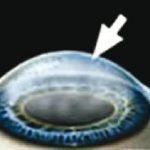 Trasplante corneal Figura 1
