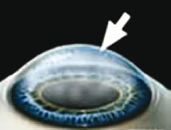 Trasplante corneal Figura 1