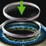 figura 3. TrasplanteCorneal