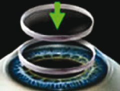 figura 3. TrasplanteCorneal