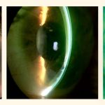Imagen lentes esclerales MSK (3)