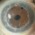 conoptica lentes esclerales