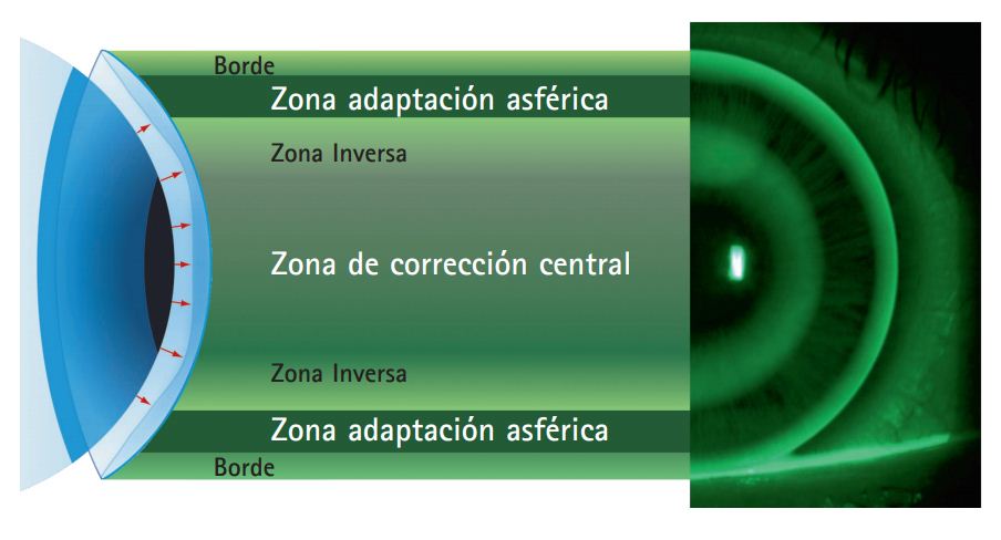 Tecnología de lentes de contacto