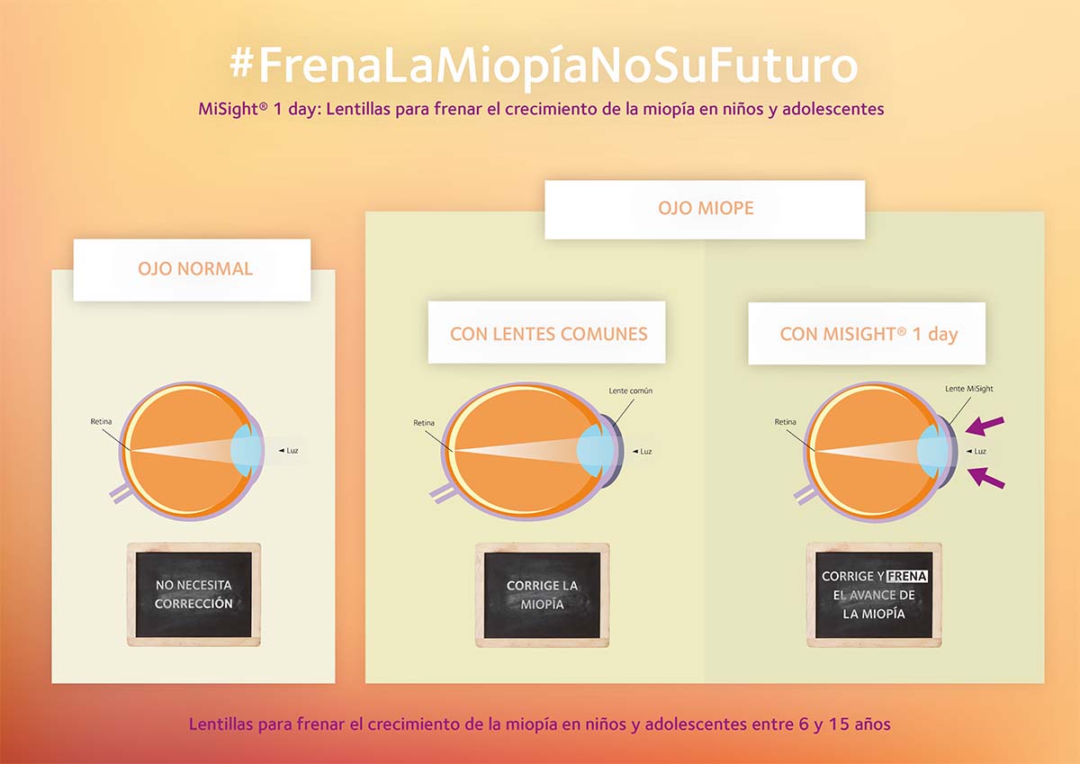 INFOGRAFIA solucion a la miopia Optimoda